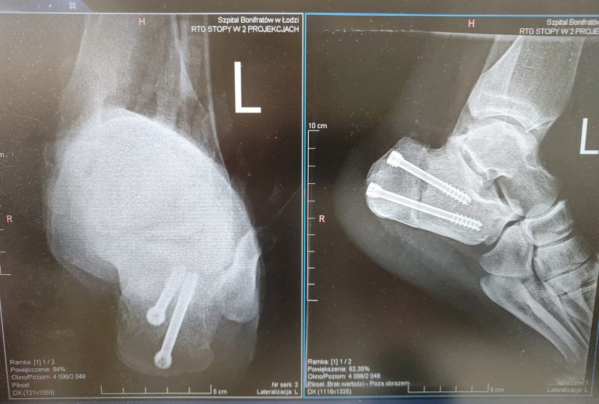 Zdjęcia RTG stopy w dwóch projekcjach – widoczne śruby stabilizujące kość po zabiegu operacyjnym