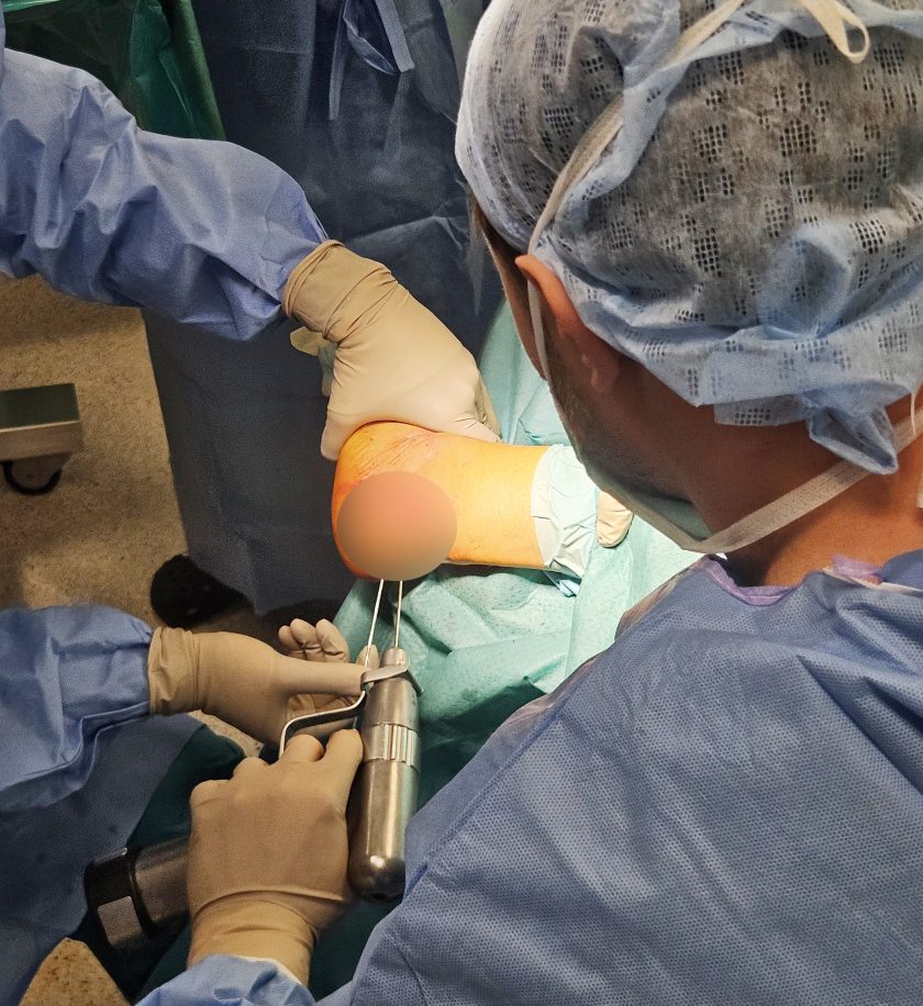 Zbliżenie na zabieg ortopedyczny stopy – chirurg używa narzędzia do wprowadzenia śrub, drugi członek zespołu stabilizuje kończynę pacjenta